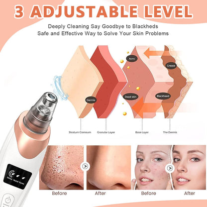 Blackhead Remover Vacuum Kit